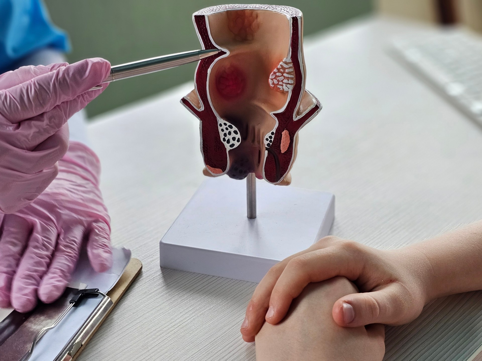 جراحة البواسير: متى تصبح ضرورة حتمية؟ ودليلك الشامل للتعافي السريع