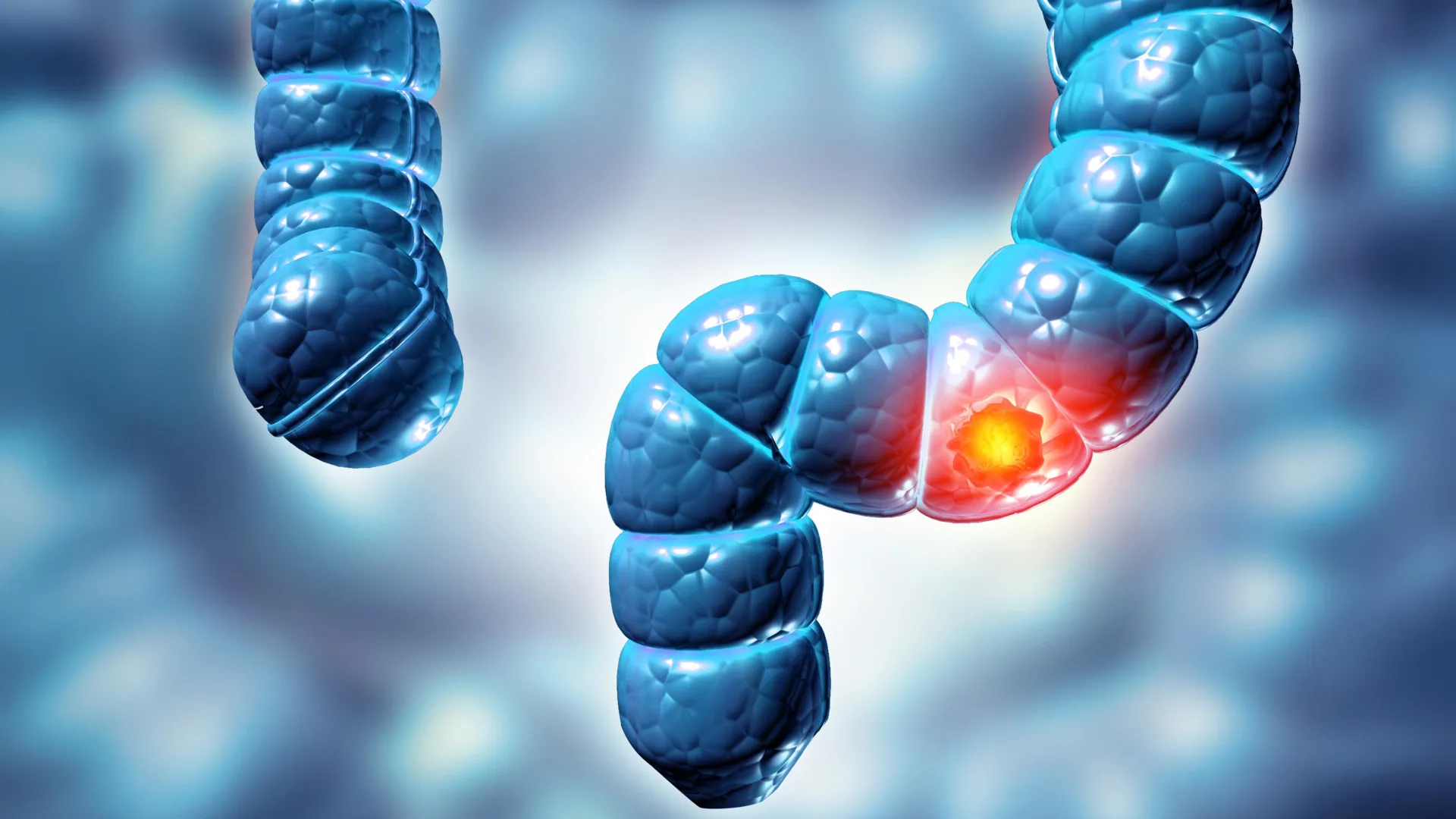 سرطان القولون والمستقيم