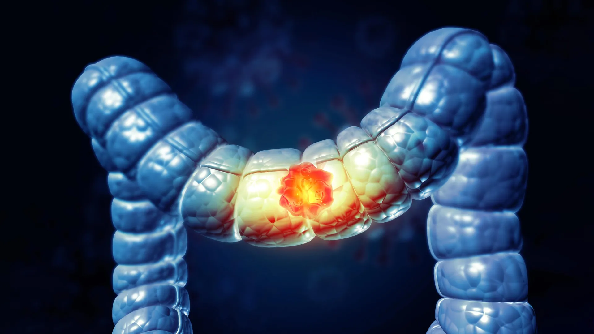 الفجوة المعرفية حول سرطان القولون والمستقيم: دراسة تحذر من نقص الوعي بمخاطر اللحوم المصنعة